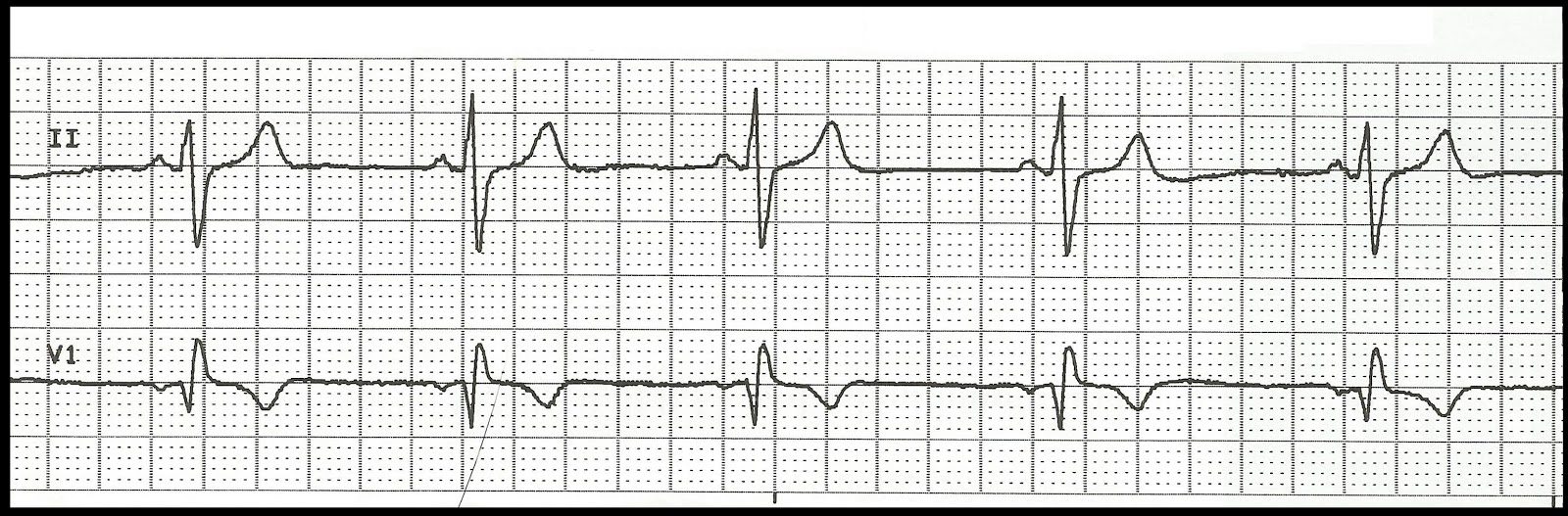 regularity of ekg strips competition human sperm